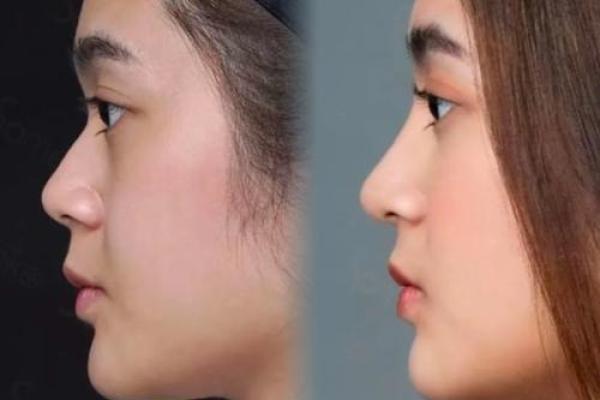 低鼻梁怎么办 低鼻梁怎么办